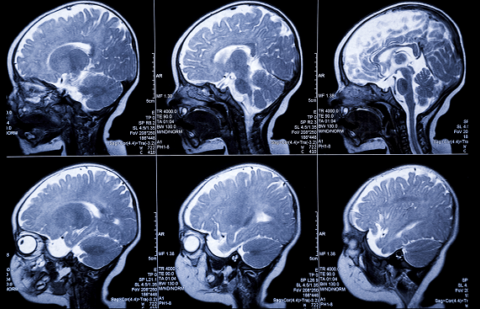 Estrogen brains